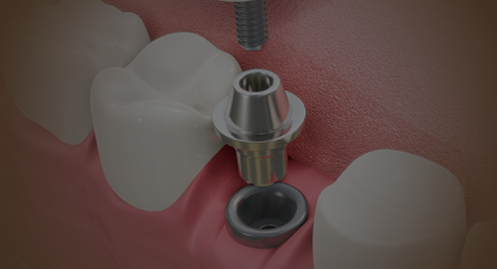 dental-implant